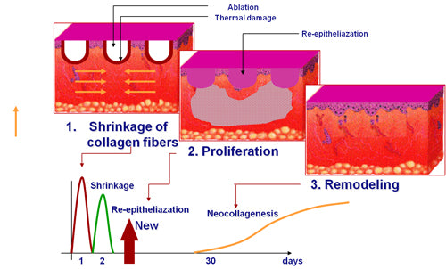 Image showing Shrinkage, Proliferation and Remodeling of Collagen fibers. DEKA DOT Fractional CO2 Laser Machine is a great value aesthetic laser purchase.