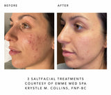 Before and after comparison of a woman's face with acne treatment, courtesy of Emme Med Spa.