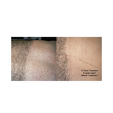 Before and after comparison of a back treatment on a person's skin.