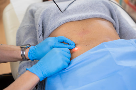 Person receiving a LASEMAR 1500 laser treatment on a leg with blue gloves