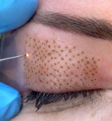 Treatment of upper eye's skin by Plasma Pen.