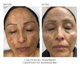 Before and after salt facial treatment comparison on a person's face, courtesy of Revenge MD.