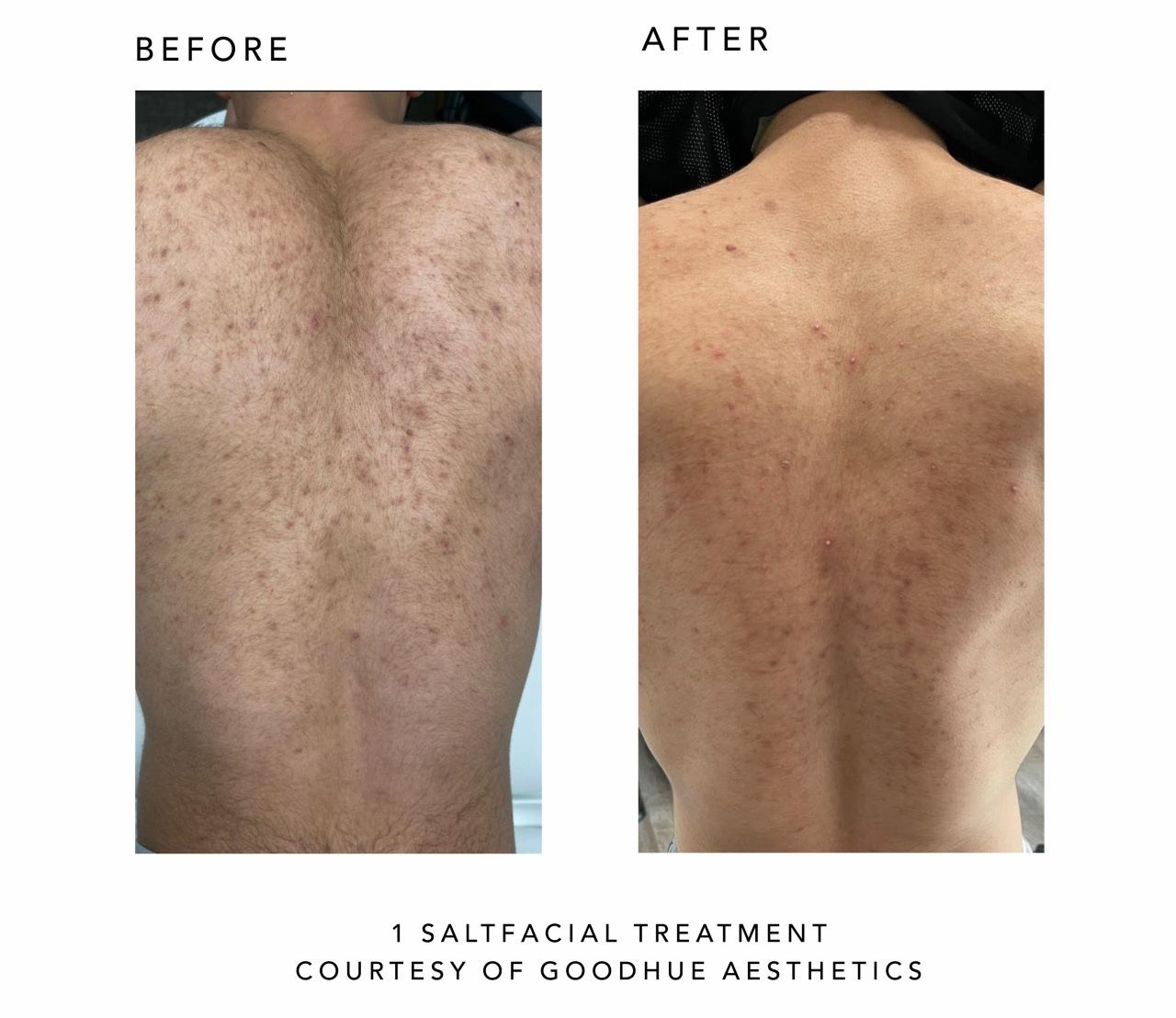 Before and after comparison of a salt facial treatment on a person's back, courtesy of Goodhue Aesthetics.