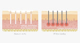 Diagram comparing collagen stimulation and skin regeneration with RF micro-needling on a white background. It is an ideal device purchase.