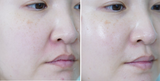 Liften S Ultrasound Skin Rejuvenation Device