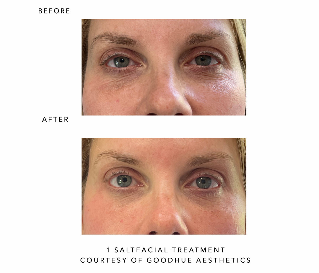 Before and after comparison of a Saltfacial treatment courtesy of Goodhue Aesthetics.