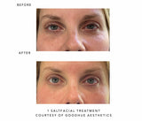 Before and after comparison of a Saltfacial treatment courtesy of Goodhue Aesthetics.