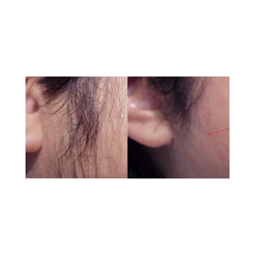 Before and after comparison of hair reduction on the side, showing a small red mark. It is an ideal device purchase.