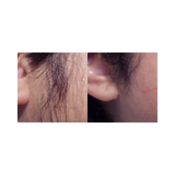 Before and after comparison of hair reduction on the side, showing a small red mark. It is an ideal device purchase.