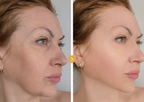 Four Color LED Therapy Silicone Mask - App Controlled