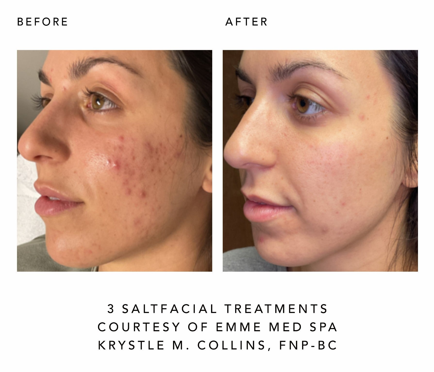 Before and after comparison of a woman's face with acne treatment, courtesy of Emme Med Spa.