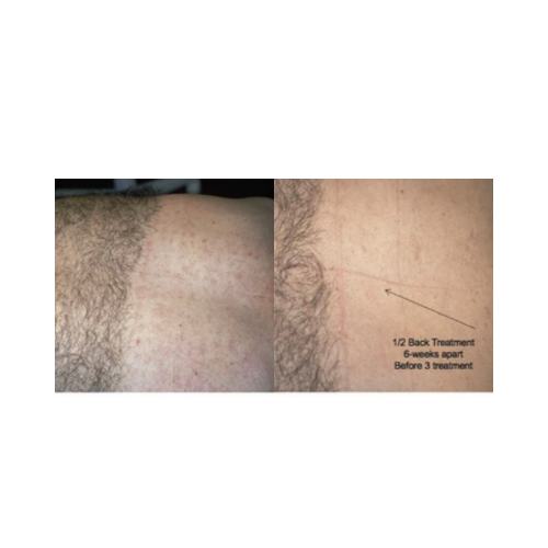 Before and after comparison of a back treatment on a person's skin. 