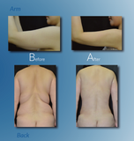 LIPOSAVER LS-2000 - Ultrasound Liposuction And Body Contouring