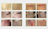 Professional Pico Laser