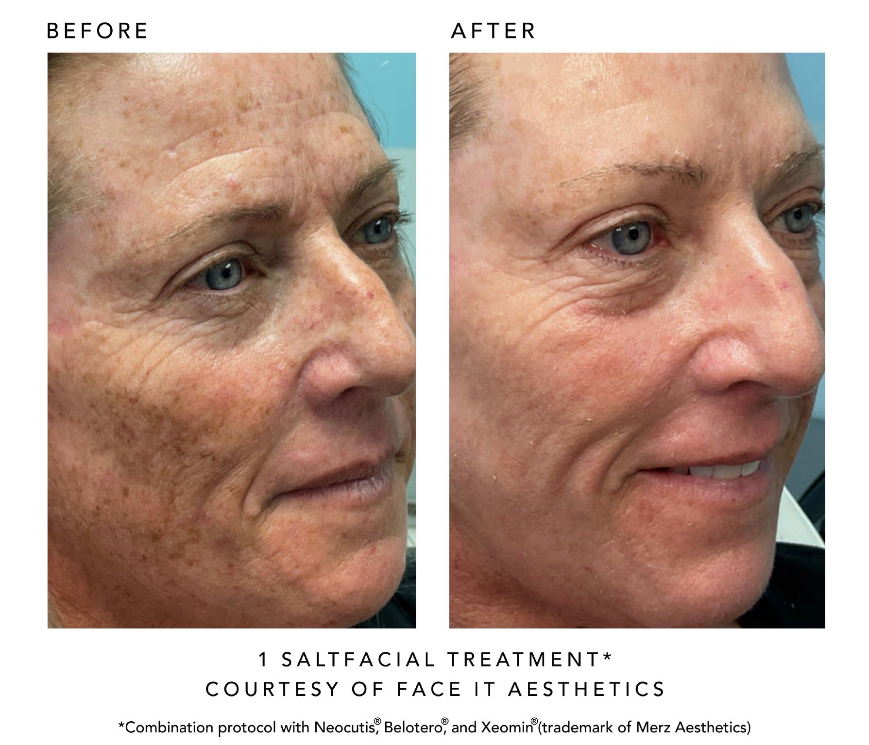 Before and after comparison of a Salt facial treatment on a person's face, courtesy of Face It Aesthetics.